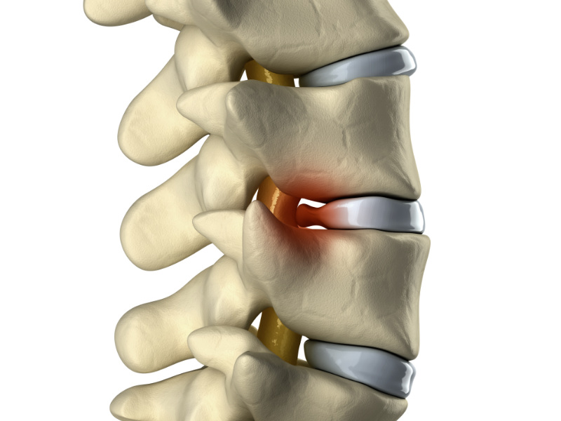 Why See A Chiropractor for Herniated Disc Pain? - Chiro One