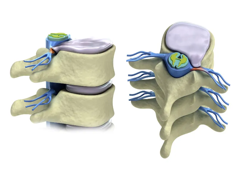 Herniated Disc Chiropractor San Diego CA  Natural/Chiropractic Treatment  For Herniated Disc